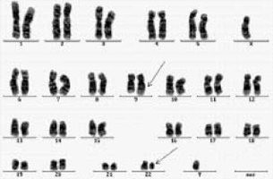 Chyby chromozomů